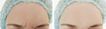 Female forehead wrinkles before  after correction procedures Royalty Free Stock Photo