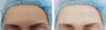 Female forehead wrinkles before after procedures Royalty Free Stock Photo