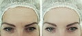 Female forehead wrinkles before  after procedures Royalty Free Stock Photo