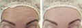 Female forehead wrinkles before after procedures therapy Royalty Free Stock Photo