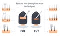 Female hair transplantation FUE and FUT infographic Royalty Free Stock Photo