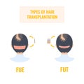 Female hair transplantation infographics of FUT and FUE methods Royalty Free Stock Photo