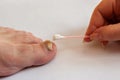 The female hand applies a cotton swab cream to the toenail affected by the fungus.