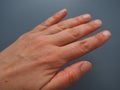 Female hand with dry atopic skin. White background. Close-up of the skin on the palm and fingers. Derma in need of care