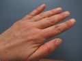 Female hand with dry atopic skin. White background. Close-up of the skin on the palm and fingers. Derma in need of care