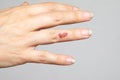 female hand with impetigo, a bacterial infection that causes skin lesions Royalty Free Stock Photo