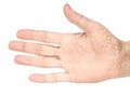 Female hands psoriasis