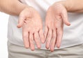 Female hands psoriasis