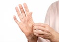 Female hands psoriasis