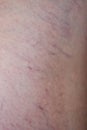 Female leg close up with incipient varicose veins