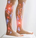 Female legs in compression stockings for varicose veins on the legs. White background. Circulation in the legs