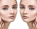 Female nose before and after cosmetic surgery. Royalty Free Stock Photo