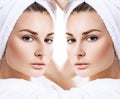 Female nose before and after cosmetic surgery. Royalty Free Stock Photo