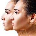 Female nose before and after cosmetic surgery. Royalty Free Stock Photo