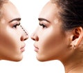 Female nose before and after cosmetic surgery. Royalty Free Stock Photo