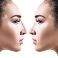 Female nose before and after cosmetic surgery. Royalty Free Stock Photo