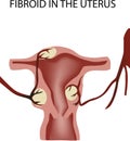 Female organ tumor disease fibroid-