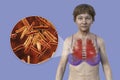 A female patient with lungs affected by miliary tuberculosis and close-up view of Mycobacterium tuberculosis bacteria