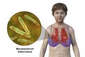 A female patient with lungs affected by miliary tuberculosis and close-up view of Mycobacterium tuberculosis bacteria