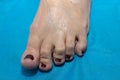 Close up of left foot with rheumatoid arthritis