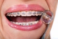 Female patient showing her lingual braces on dental mirror