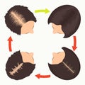 Female pattern hair loss stages