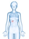 A femaleÃÂ´s gallbladder cancer