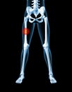 Female skeleton with broken leg bone Royalty Free Stock Photo