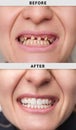 female smile after and before dental Royalty Free Stock Photo
