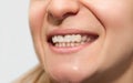 Female smile with poor quality tooth crown flat color, bad shape