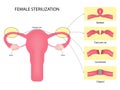 Female sterilization, Tubal ligation