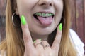 Female teeth with green dental braces.