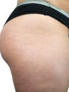 Female thigh legs with cellulite. Skin problem, topic entry, explosive weight and diet, diabetes risk factor Royalty Free Stock Photo