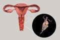 Female trichomoniasis, illustration showing vaginitis and close-up view of Trichomonas vaginalis parasite Royalty Free Stock Photo