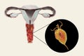 Female trichomoniasis, illustration showing vaginitis and close-up view of Trichomonas vaginalis parasite