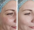 Female wrinkles before after effect lifting correction procedures Royalty Free Stock Photo