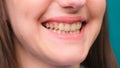 Female Yellow teeth, fluorosis. Smokers problem teeth caused by fluoride, smoking, or coffee. Brown tooth enamel due to Royalty Free Stock Photo