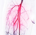 Femoral artery angiogram or angiography