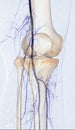 Femoral artery angiogram or angiography at knee area
