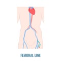 Femoral central line venous catheter close up