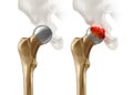 Femoral Head Disease Royalty Free Stock Photo