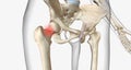 A femoral neck fracture is a type of hip fracture that occurs in the section of the femur closest to the pelvis