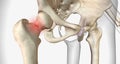 A femoral neck fracture is a type of hip fracture that occurs in the section of the femur closest to the pelvis