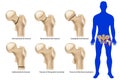 Femoral neck fracture. Types of hip fractures. Subtrochanteric, Intertrochanteric, Transcervical and Subcapital neck
