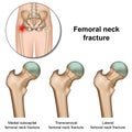 Femoral neck fractures medical illustration on white background