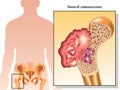 Femoral osteosarcoma