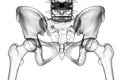 Femur bone affected by Legg-Calve-Perthes Disease, a childhood hip disorder, 3D illustration