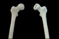 Femur bone affected by Legg-Calve-Perthes Disease, a childhood hip disorder, 3D illustration Royalty Free Stock Photo