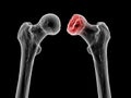 Femur bone affected by Legg-Calve-Perthes Disease, a childhood hip disorder, 3D illustration