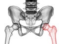 Femur bone affected by Legg-Calve-Perthes Disease, a childhood hip disorder, 3D illustration